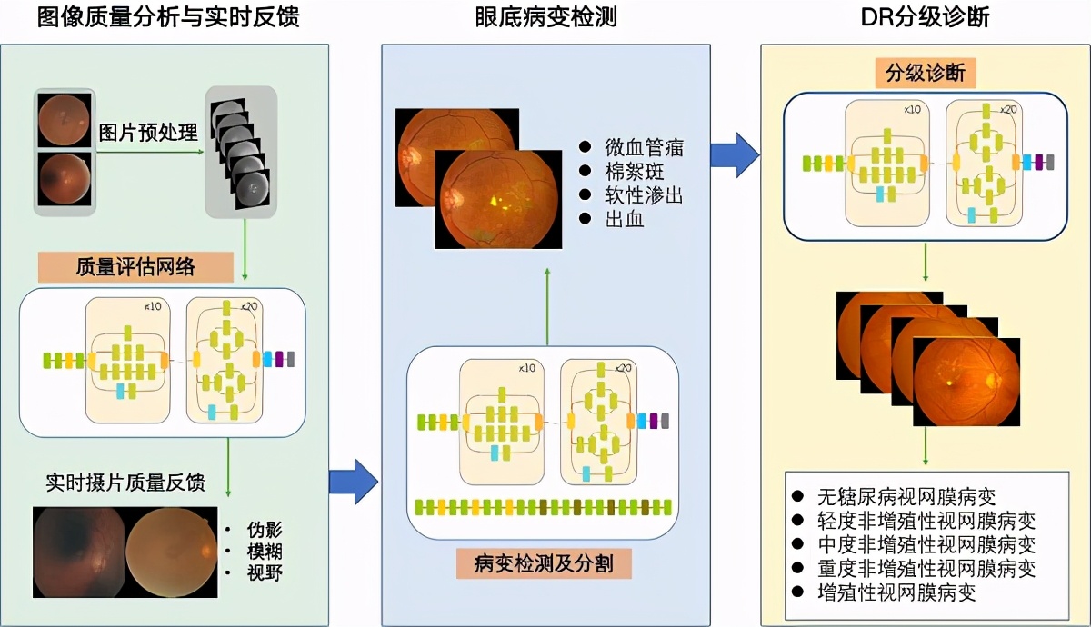 贾伟平教授团队研发人工智能系统DeepDR 精准识别糖尿病视网膜病变